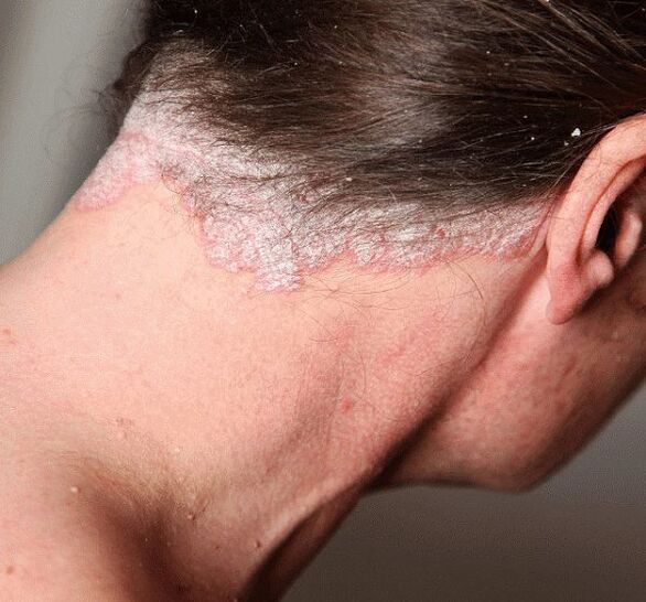 Comment traiter le psoriasis