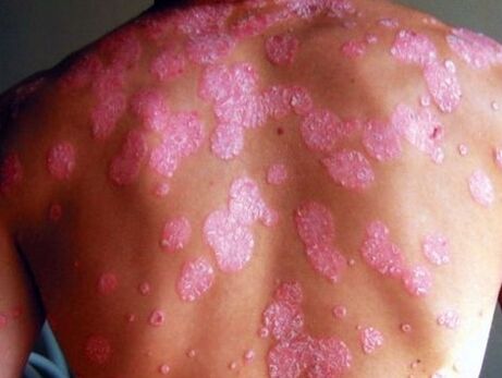 Maladie psoriatique