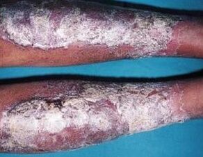 Pommade du psoriasis