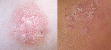 Psoriasis au stade initial